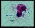 encapsulated pneumococci in sputum, Gram, pneumococcus capsule